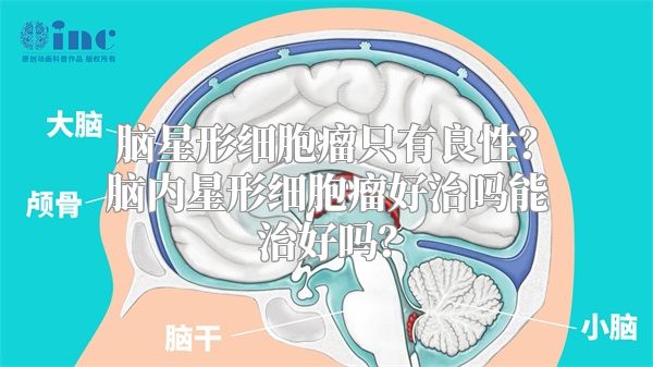 脑星形细胞瘤只有良性？脑内星形细胞瘤好治吗能治好吗？