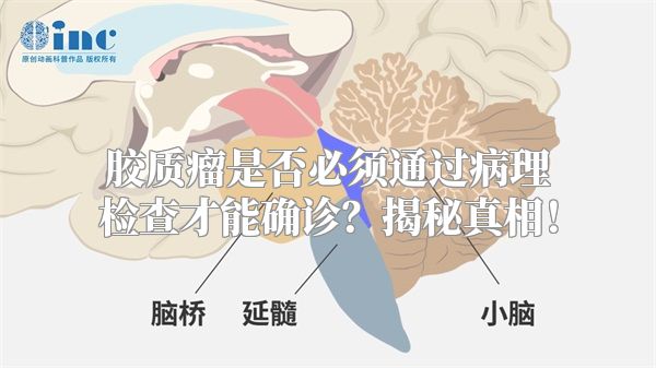 胶质瘤是否必须通过病理检查才能确诊？揭秘真相！