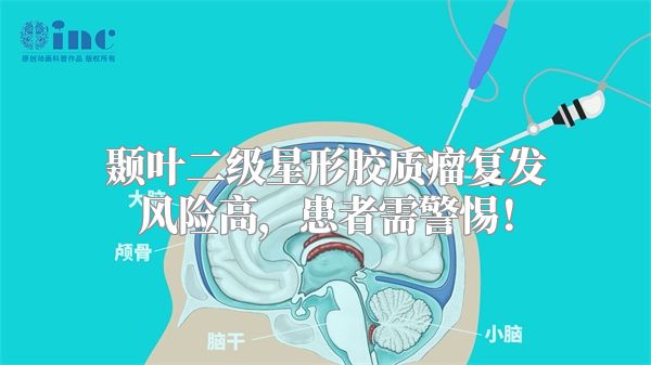 颞叶二级星形胶质瘤复发风险高，患者需警惕！