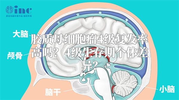 胶质母细胞瘤4级复发率高吗？4级生存期个体差异？