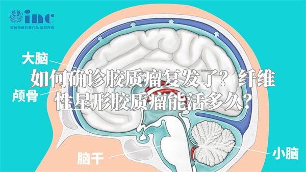 如何确诊胶质瘤复发了？纤维性星形胶质瘤能活多久？