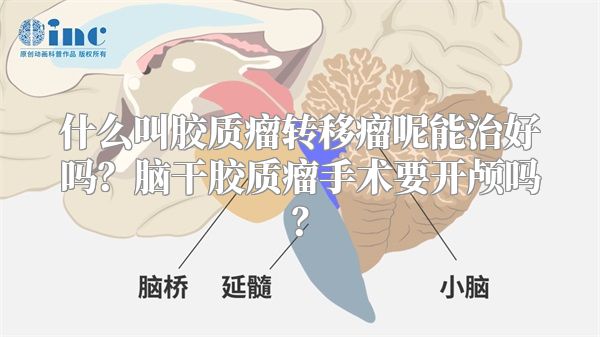 什么叫胶质瘤转移瘤呢能治好吗？脑干胶质瘤手术要开颅吗？