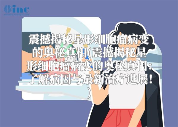 震撼揭秘星形细胞瘤病变的奥秘真相(震撼揭秘星形细胞瘤病变的奥秘真相：了解病因与最新治疗进展！)