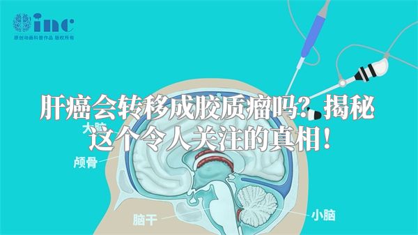 肝癌会转移成胶质瘤吗？揭秘这个令人关注的真相！