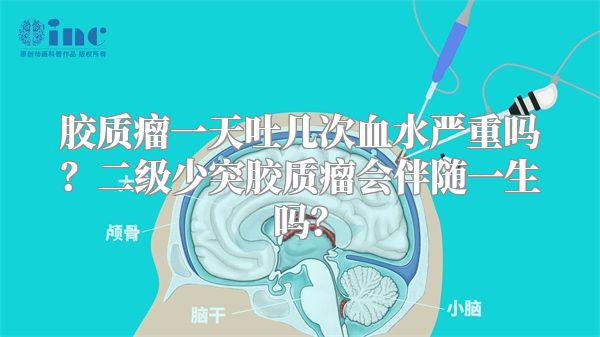 胶质瘤一天吐几次血水严重吗？二级少突胶质瘤会伴随一生吗？