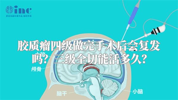 胶质瘤四级做完手术后会复发吗？三级全切能活多久？
