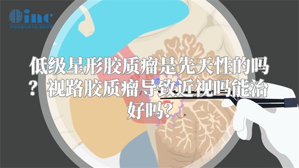 低级星形胶质瘤是先天性的吗？视路胶质瘤导致近视吗能治好吗？