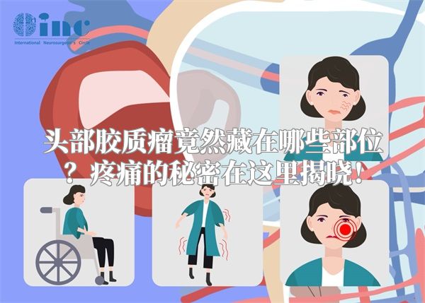 头部胶质瘤竟然藏在哪些部位？疼痛的秘密在这里揭晓！