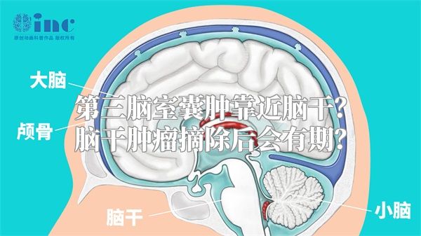 第三脑室囊肿靠近脑干？脑干肿瘤摘除后会有期？