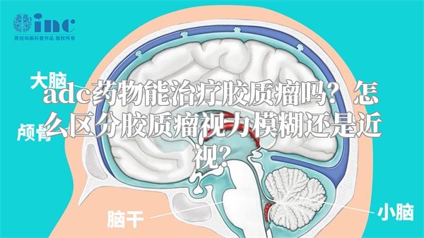 adc药物能治疗胶质瘤吗？怎么区分胶质瘤视力模糊还是近视？