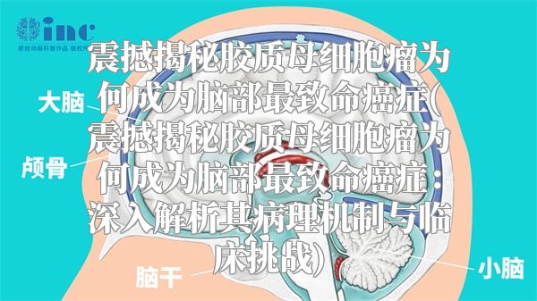 震撼揭秘胶质母细胞瘤为何成为脑部最致命癌症(震撼揭秘胶质母细胞瘤为何成为脑部最致命癌症：深入解析其病理机制与临床挑战)