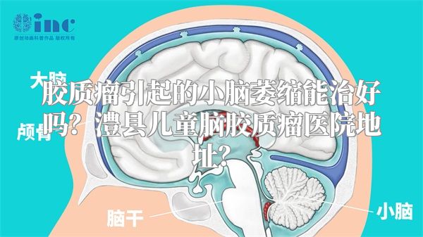 胶质瘤引起的小脑萎缩能治好吗？澧县儿童脑胶质瘤医院地址？