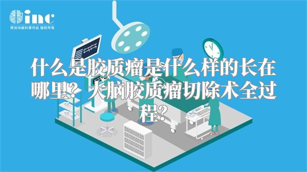 什么是胶质瘤是什么样的长在哪里？大脑胶质瘤切除术全过程？