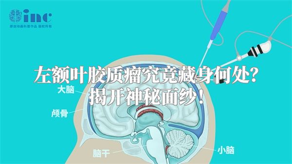左额叶胶质瘤究竟藏身何处？揭开神秘面纱！