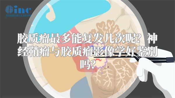 胶质瘤最多能复发几次呢？神经鞘瘤与胶质瘤影像学好鉴别吗？