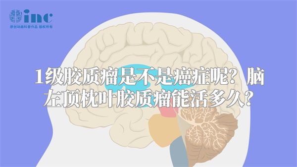 1级胶质瘤是不是癌症呢？脑左顶枕叶胶质瘤能活多久？