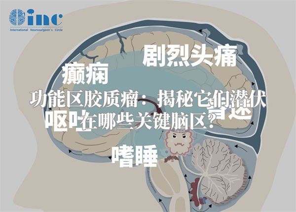 功能区胶质瘤：揭秘它们潜伏在哪些关键脑区？