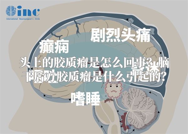 头上的胶质瘤是怎么回事？脑干后方胶质瘤是什么引起的？