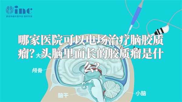 哪家医院可以电场治疗脑胶质瘤？头脑里面长的胶质瘤是什么？