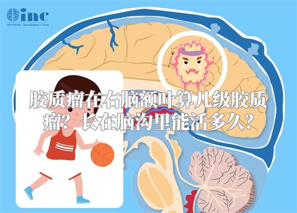胶质瘤在右脑额叶算几级胶质瘤？长在脑沟里能活多久？