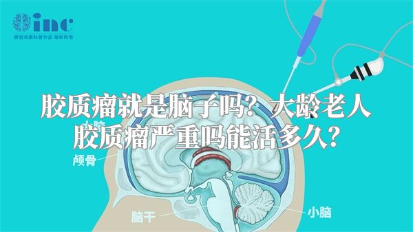 胶质瘤就是脑子吗？大龄老人胶质瘤严重吗能活多久？