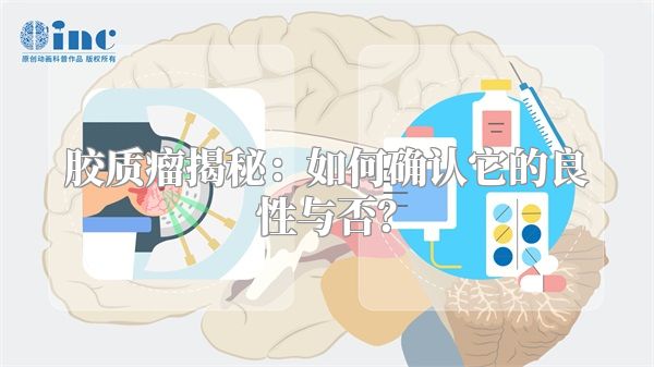 胶质瘤揭秘：如何确认它的良性与否？