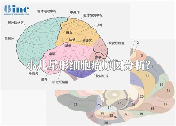小儿星形细胞瘤原因分析？