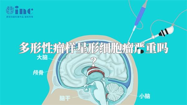 多形性瘤样星形细胞瘤严重吗？