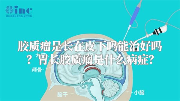 胶质瘤是长在皮下吗能治好吗？胃长胶质瘤是什么病症？