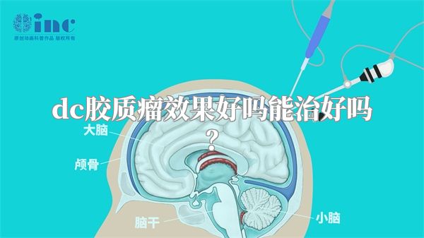 dc胶质瘤效果好吗能治好吗？
