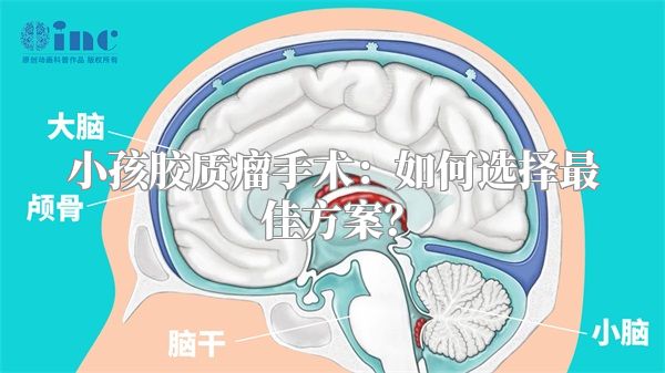 小孩胶质瘤手术：如何选择最佳方案？