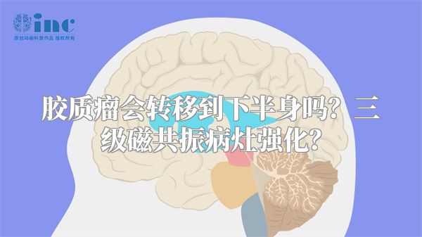 胶质瘤会转移到下半身吗？三级磁共振病灶强化？