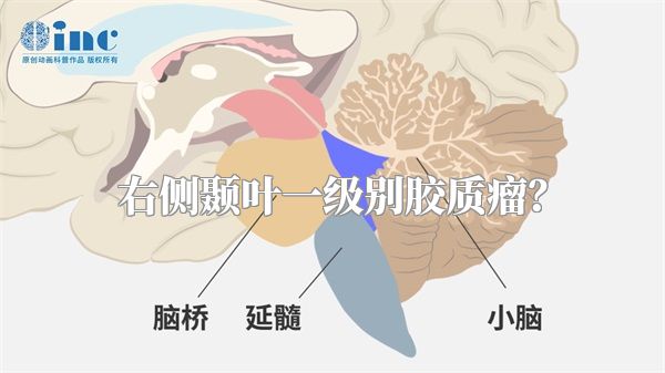右侧颞叶一级别胶质瘤？