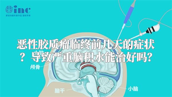 恶性胶质瘤临终前几天的症状？导致严重脑积水能治好吗？