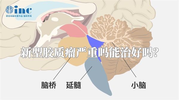 新型胶质瘤严重吗能治好吗？