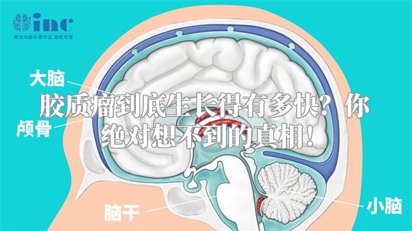 胶质瘤到底生长得有多快？你绝对想不到的真相！