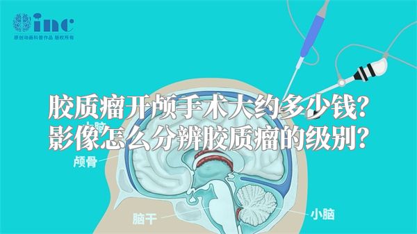 胶质瘤开颅手术大约多少钱？影像怎么分辨胶质瘤的级别？