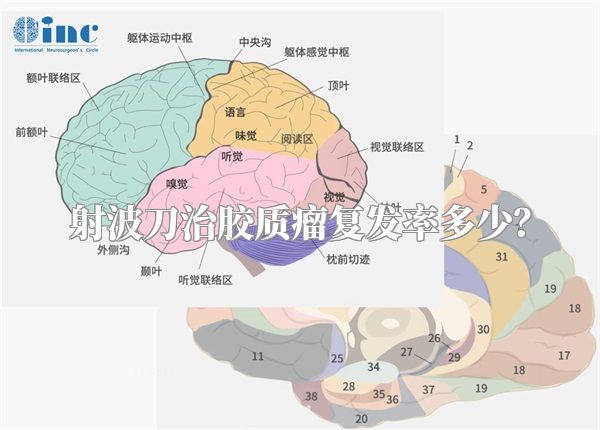 射波刀治胶质瘤复发率多少？