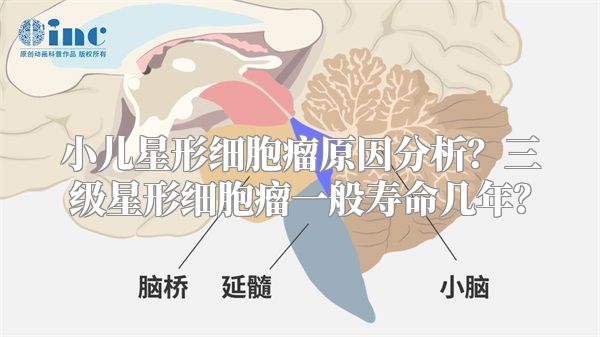 小儿星形细胞瘤原因分析？三级星形细胞瘤一般寿命几年？