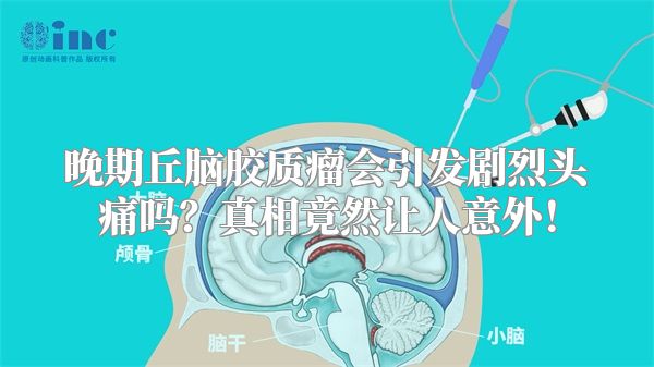 晚期丘脑胶质瘤会引发剧烈头痛吗？真相竟然让人意外！