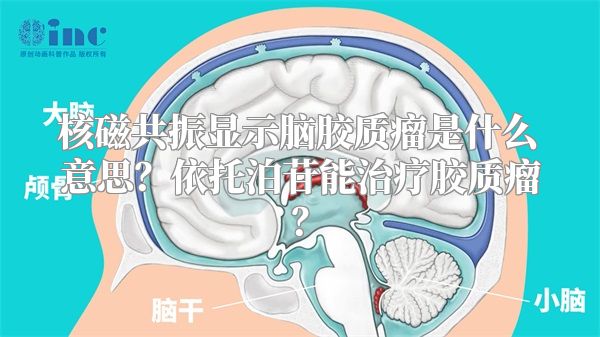 核磁共振显示脑胶质瘤是什么意思？依托泊苷能治疗胶质瘤？