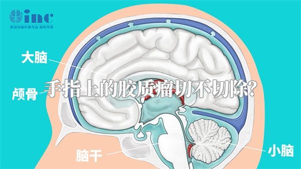 手指上的胶质瘤切不切除？