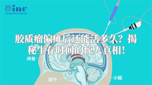 胶质瘤偏瘫后还能活多久？揭秘生存时间的惊人真相！