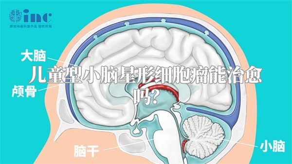 儿童型小脑星形细胞瘤能治愈吗？