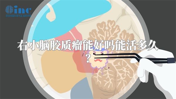 右小脑胶质瘤能好吗能活多久？