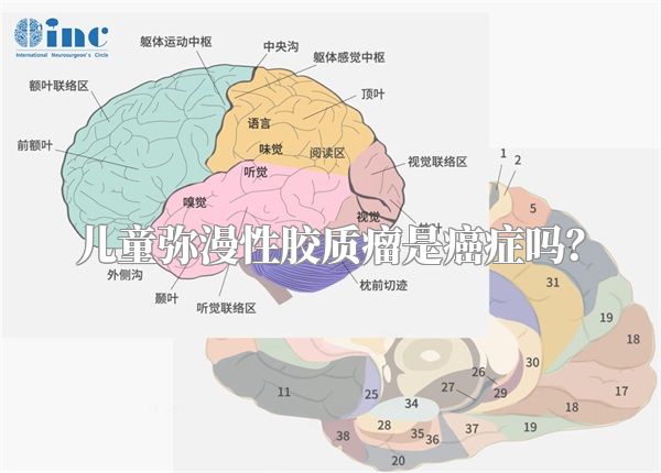 儿童弥漫性胶质瘤是癌症吗？