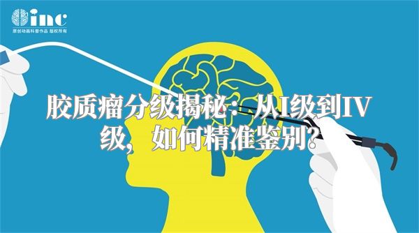 胶质瘤分级揭秘：从I级到IV级，如何精准鉴别？