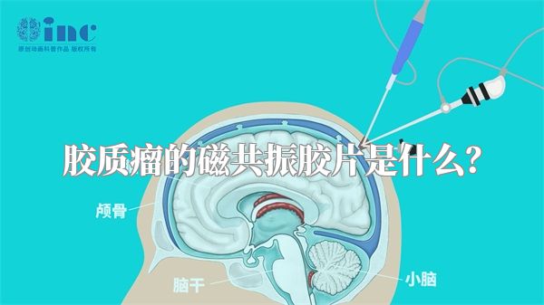 胶质瘤的磁共振胶片是什么？