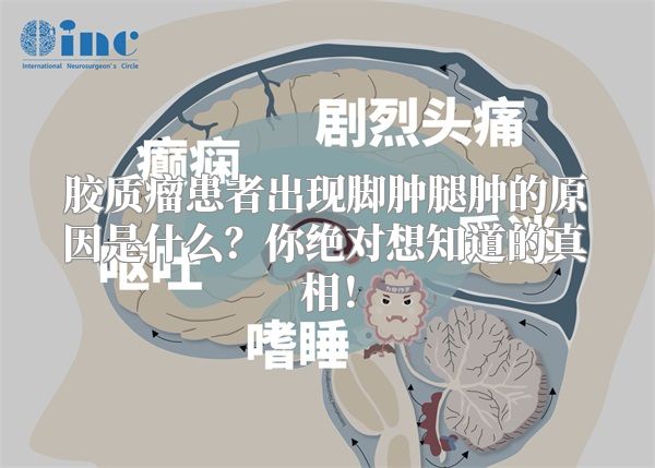 胶质瘤患者出现脚肿腿肿的原因是什么？你绝对想知道的真相！