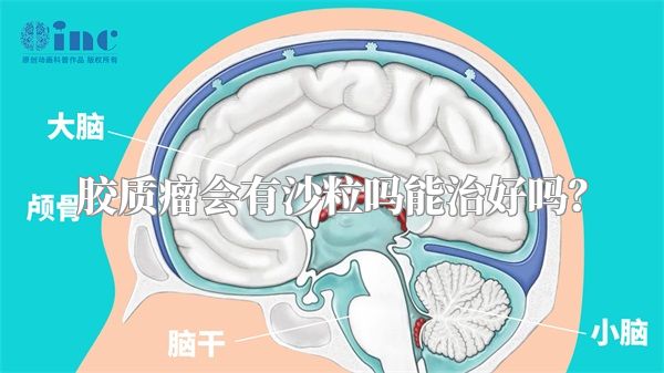 胶质瘤会有沙粒吗能治好吗？